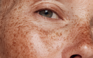 The 5 Biggest Triggers Of Pigmentation (And How To Avoid Them)