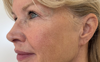 Why Are My Age Spots Getting Darker As I Get Older?