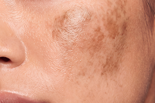 how to get rid of dark spots on face