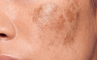 How to treat dark spots on the face