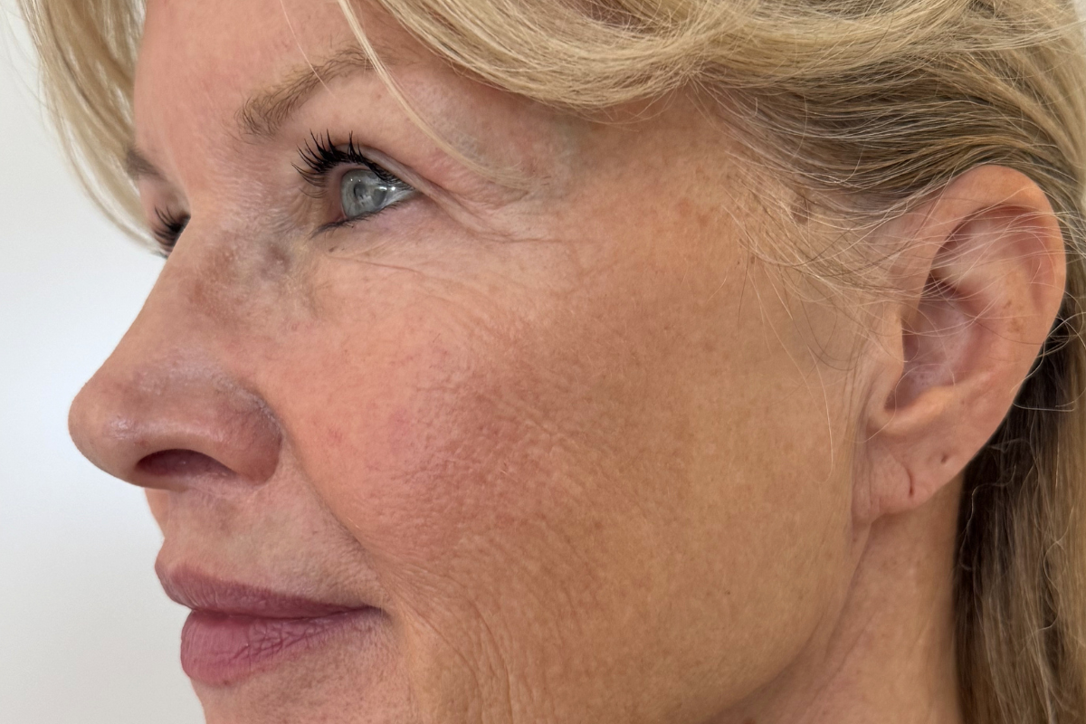 Why Are My Age Spots Getting Darker As I Get Older?