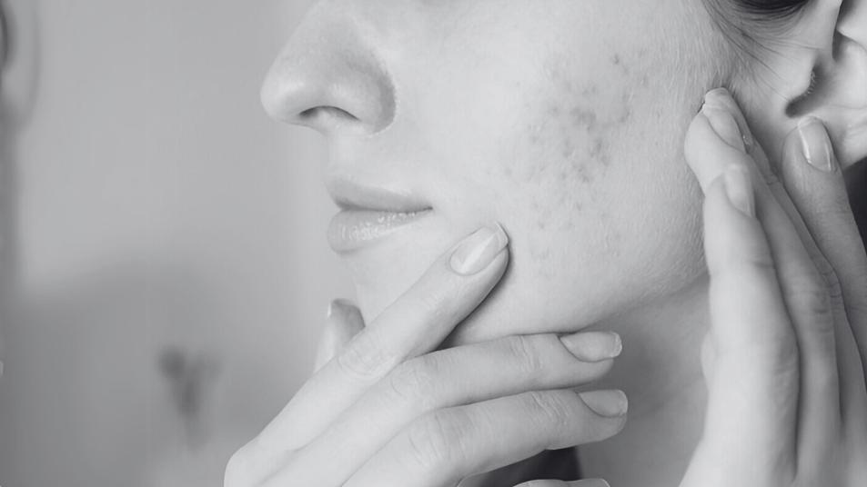 Acne Prone - The Skincare Tools