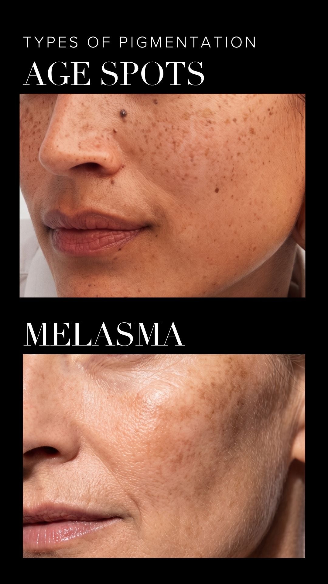 what is hyperpigmentation on face