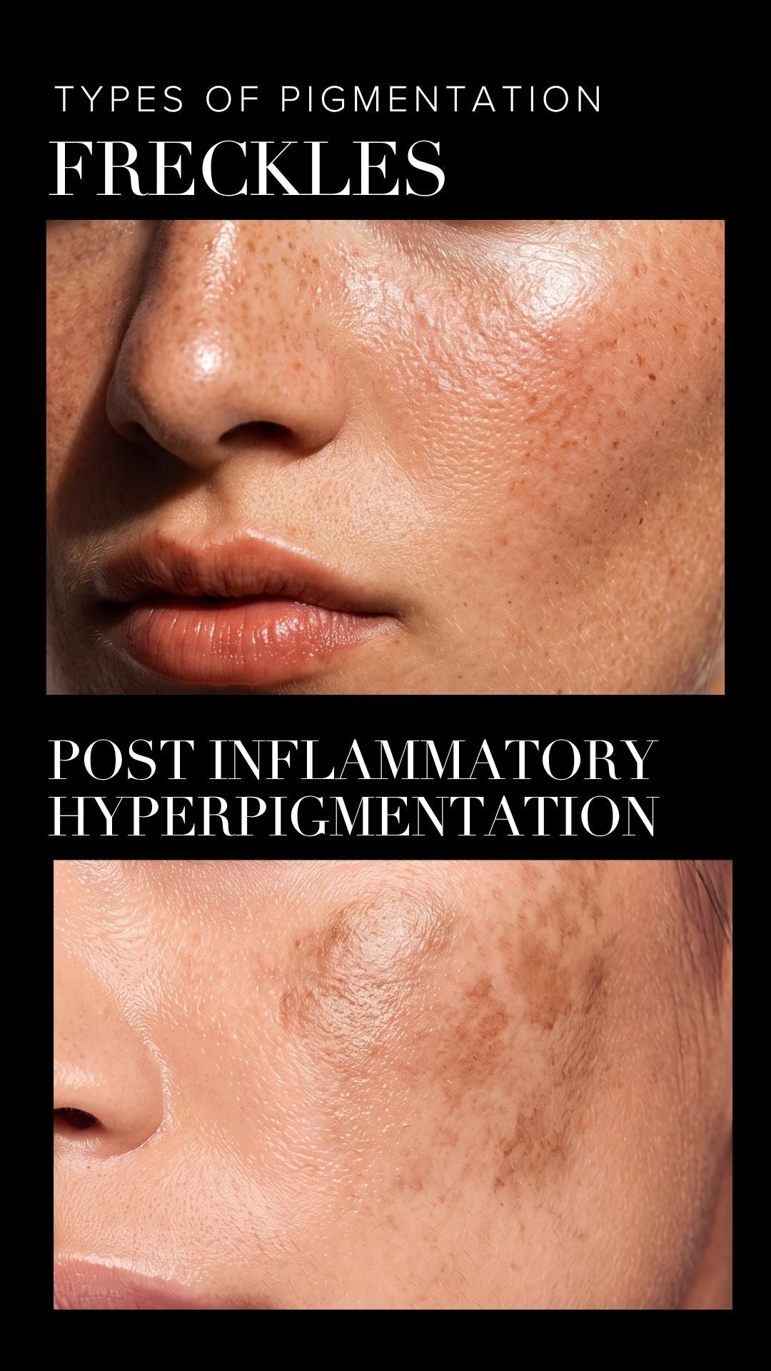 types of pigmentation and red light therapy for hyperpigmentation