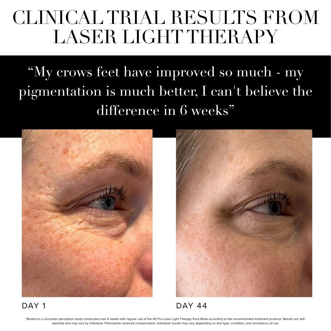 wrinkles before and after laser 